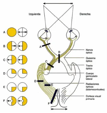 Fig  1.  Defectos  de  campo  visual  y  su  correspondiente  localización  cerebral. Fuente:  12
