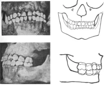 Fig. 7. Frente y perfil del aparato dentario de un niño de 4 1/2 años de edad 
