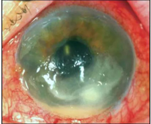 Fig. 5 Oncocercosis ocular                                                      Fig.6 Microfilaria: produce Oncocercosis                                                                                                                    