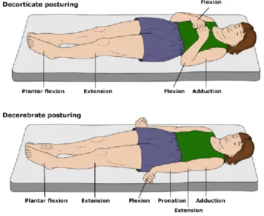 Figura  1.  Evaluación  de  la  respuesta  motora.  Postura  de  decorticación,  postura  de  descerebración 3 