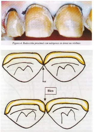 Figura 4. Reducción proximal con márgenes en áreas no visibles.