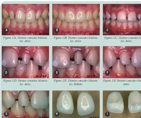 Figura 12A. Dientes conoides bilatera-