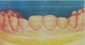 Fig. 2.10.2.1.3 (Fuente: Pág.:18; Estética Dental Carillas de Porcelana; M. Haga).  Las partículas del material refractario son gruesas, duras y frágiles; por ello el modelo maestro debe desgastarse previamente