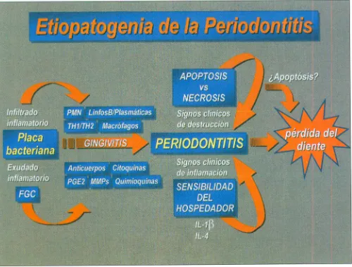 Fig. 8. Etiopatogenia de la periodontitis.