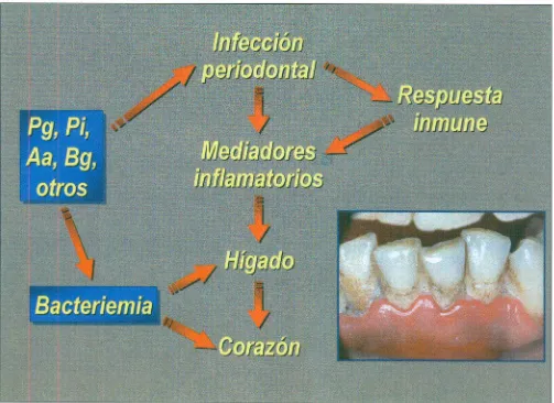 Fig. 5. Periodontopatógenosimplicadosen la infecCÍón.
