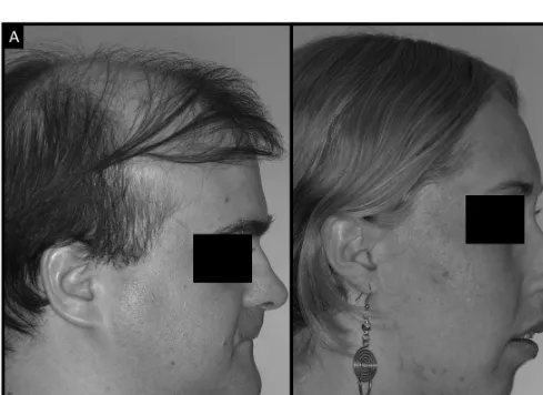 Fig. 1. A. Paciente con síndrome facial corto donde es posible identificar un perfil facial cóncavo y un plano mandibularcerrado; B