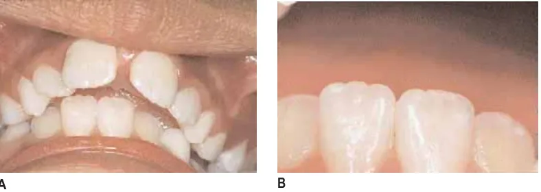 Fig. 1-10. A y B. Permanencia de la flor de lis en un adulto.