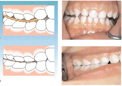 Fig. 1-6. A. Lado de trabajo. Dentición temporaria con desoclusión canina. B. Dentición temporariacon función de grupo.