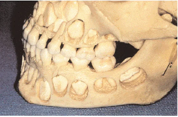 Fig. 1-7. Cráneo con dentición temporaria. Vista lateral. Cúspidedistovestibular del segundo molar temporario descendida.