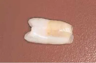 Fig. 1-8. Los dientes permanentes erupcionancon dos tercios de la longitud radicular.