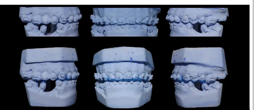 Fig.14 Se realiza el encerado de los modelos, siguiendo el diseño de sonrisa, para 