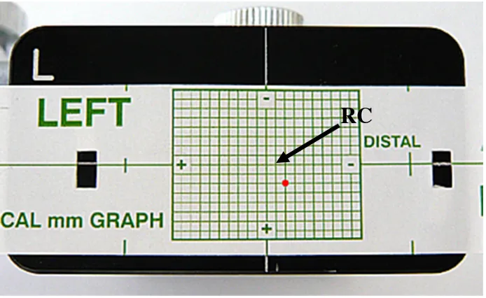 Fig. 13 Adhesivo de MCD del cóndilo del lado izquierdo. 