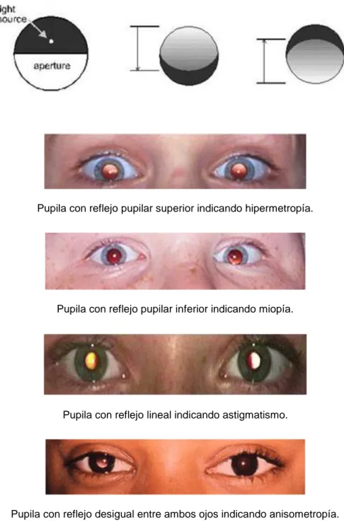 Figura  1.  Esquemáticamente  se  muestra  la  dirección  de  la  sombra  reflejada  en  la  pupila dependiendo del defecto refractivo y cuatro ejemplos de diferentes proyecciones  de la luz