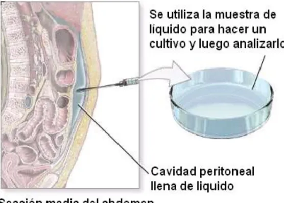 Fig. 7 Cultivo de líquido peritoneal 