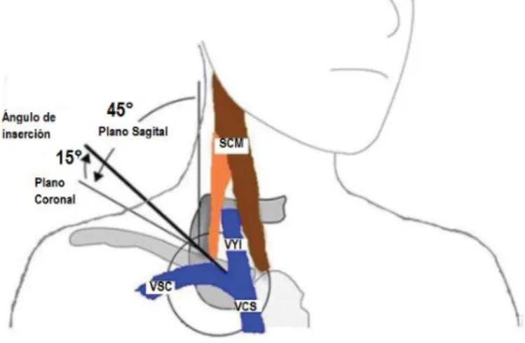 Figura 6: Abordaje subclavio supraclavicular (Técnica de Yoffa)  (44)