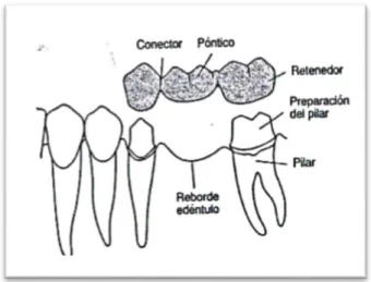 Figura N° 15.- Esquema de los componentes de una prótesis parcial fija 