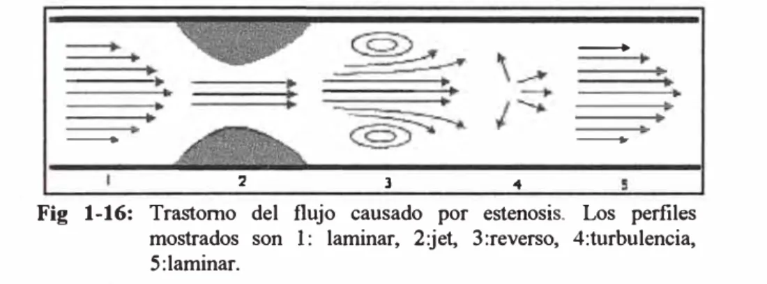 Fig  1-16:  Trastorno  del  flujo  causado  por  estenosis.  Los  perfiles  mostrados  son  1:  laminar,  2:jet,  3:reverso,  4:turbulencia,  5:laminar