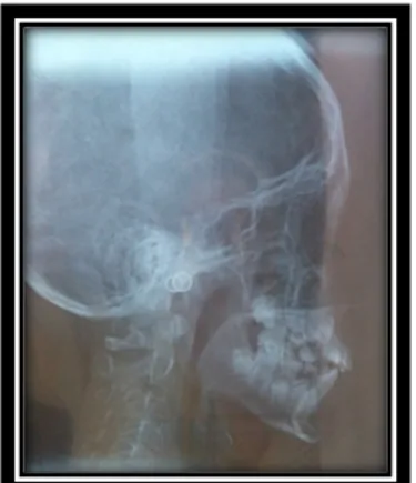 Figura 9.- Radiografía lateral de cráneo  Autor: Estrella María Gabriela, 2014. 