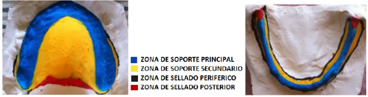 Fig. 13 Delimitación protésica superior    Fig. 14 Delimitación protésica inferior  Con la correcta delimitación de las zonas protésica, se pudo proceder a realizar la confección de  las cubetas individuales