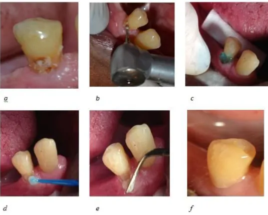 Figura 8. Tratamiento de operatoria en el diente 4.4. (a) Observamos caries en cervical del diente 4.4