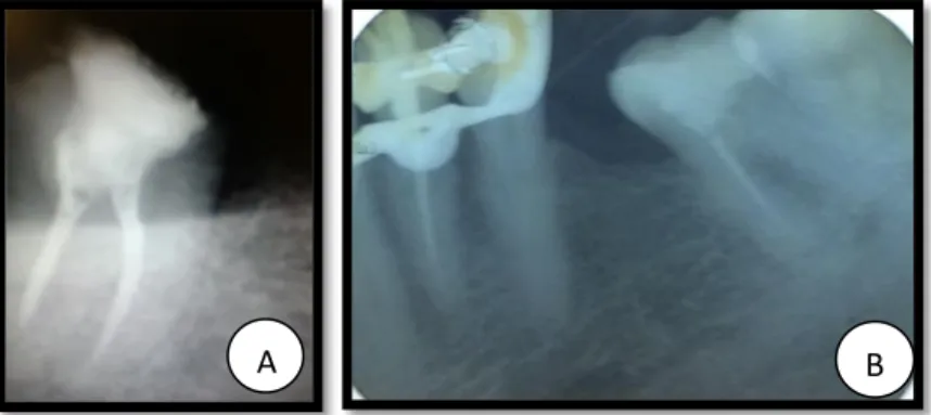 Figura 10: A, B y C) Cirugía resto radicular 4.5.  