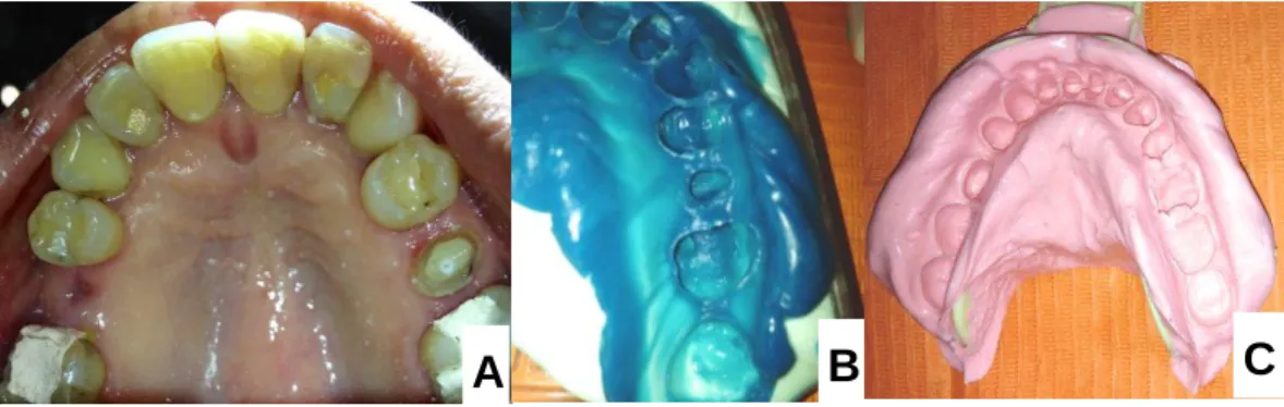 Fig 21. Realización de tallado del diente N15 y Toma de impresiones (A. 