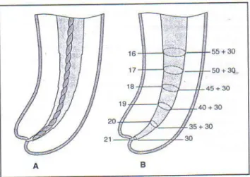 Figura 4: Preparación del conducto radicular con la técnica Step- back  A) Lima apical  maestra, B) Secuencia de retrocesos 