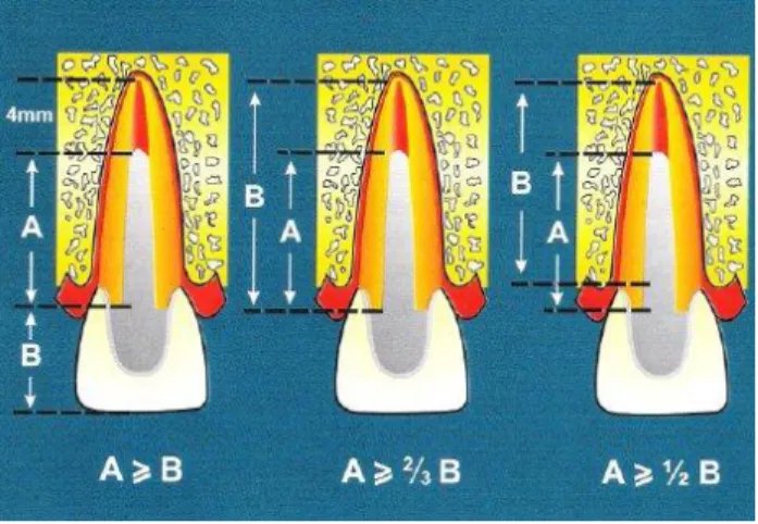 Figura 5: Esquema de la longitud del perno y el sellado apical  Elaborador y fuente: (Canalda, 2006) 