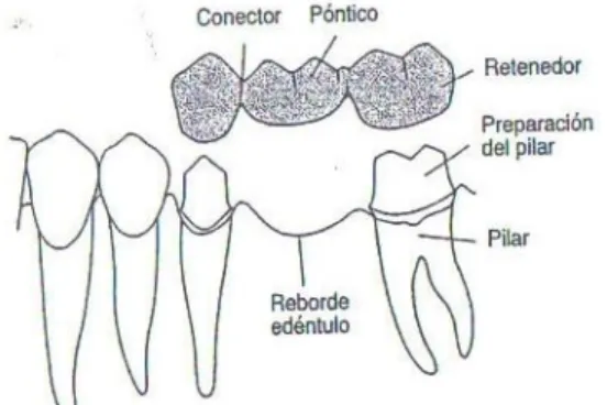 Figura 10: Esquema de los componentes de una prótesis  parcial fija 