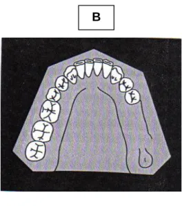 Figura 11: Esquema de la clasificación de Kennedy A) Clase I, B) Clase II, C)  Clase III, D) Clase IV 