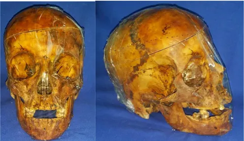 Figura  8.Fijación  de  Mandíbula  a  sus  respectivos  cráneos  para  la  toma  de  las  ayudas  diagnósticas