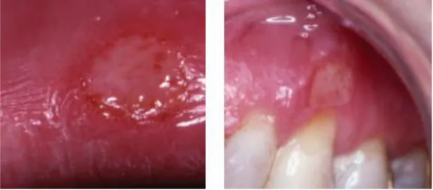 Figura  3.  Aftas  Mayores.  Tomado  de:  Rioboo  Crespo  M,  Bascones  Martínez  A.  Aftas  de  la  mucosa oral Aphthae of the oral mucosa