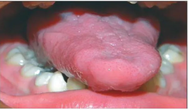 Figura 2. Macroglosia 