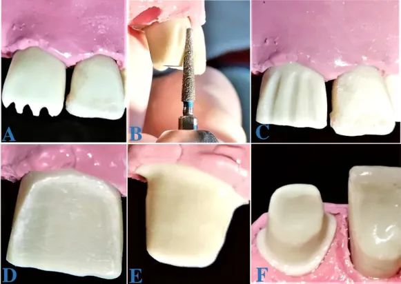 Ilustración 1. Preparación del diente #11 para una corona totalmente cerámica 
