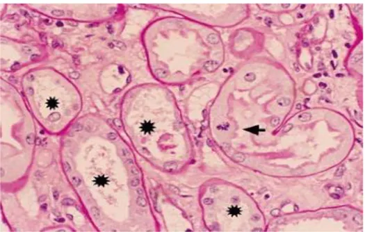 Figura  5.  Los  túbulos  dañados  (asteriscos)  muestran  pérdida  de  la  altura  celular  y  del  borde  en  cepillo con detritos dispersos en los lúmenes tubulares