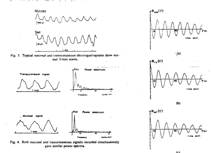 Fig.  3.  TypKsl  mucosal  and  transcutaneous electroeastrograms  show  nor- 