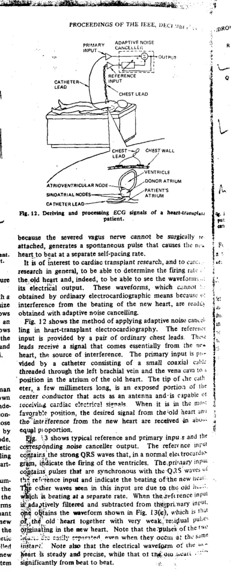 Fig.  12 shows the method  of  applying adaptive noisc cdnd  ling  in  heart-transplant  electrocardiography