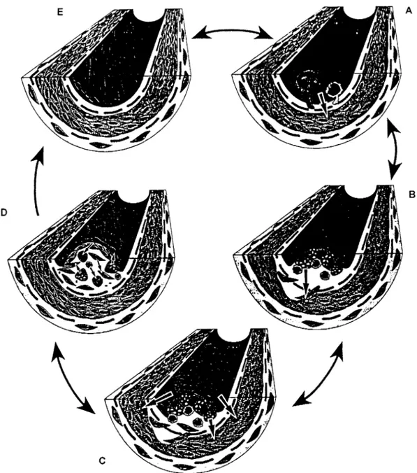 Figura  2.  Teoría  de  daño  endotelial. A)  Adhesión  de  monocitos  y  linfocitos  T  a  la  pared  de  la  arteria