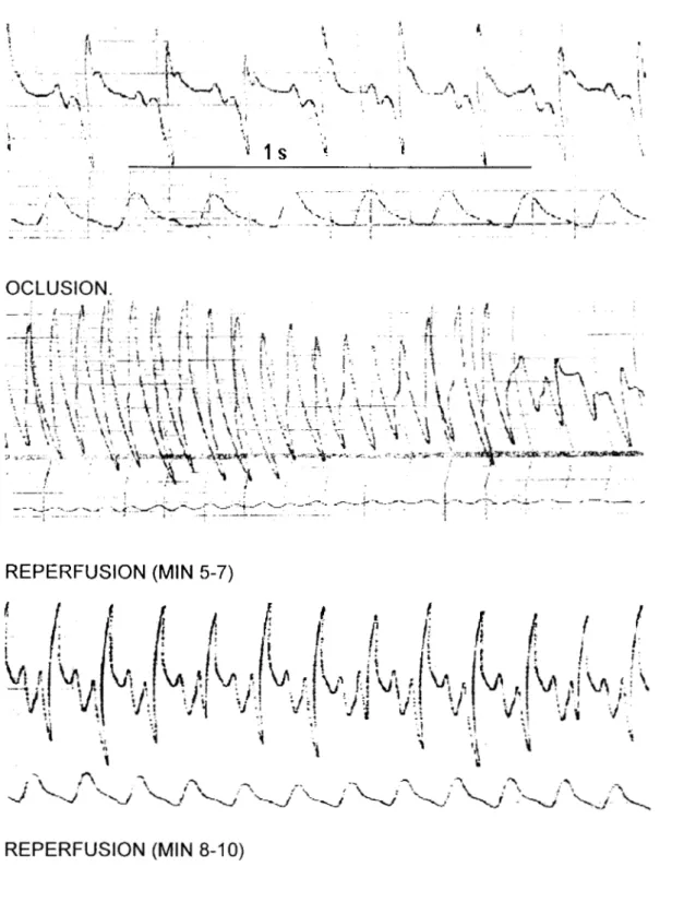Figura  11A.  Trazos  representativos  de electrocardiograma  y  señal de presión  en  la arteria 