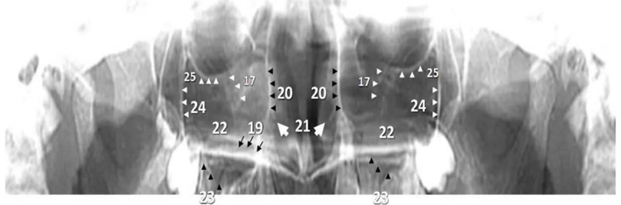 Figura 2. Identificación de algunas estructuras del maxilar superior. 19. Paladar duro, 20