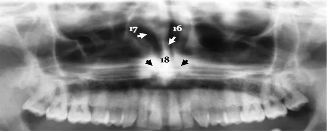 Figura 3. Estructuras anatómicas del maxilar superior. 17. Tabique nasal, 18. Tejido blando de  la nariz