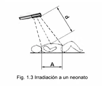 Fig. 1.3 Irradiación a un neonato 
