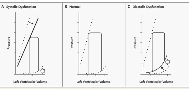 Figure 2.  Left Ventricular Pressure–Volume Loops in Systolic and Diastolic Dysfunction.