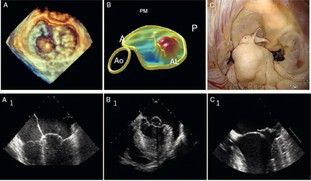 Figura 4: Visualización IM ecocardiografía y ecocardiografía 3D. 