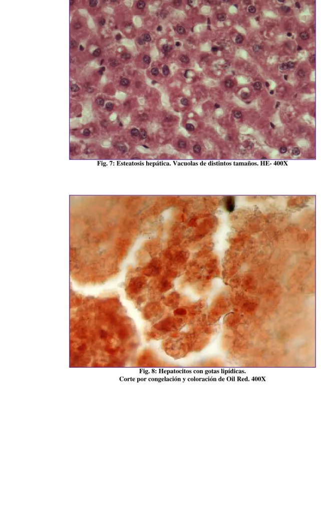 Fig. 8: Hepatocitos con gotas lipídicas. 