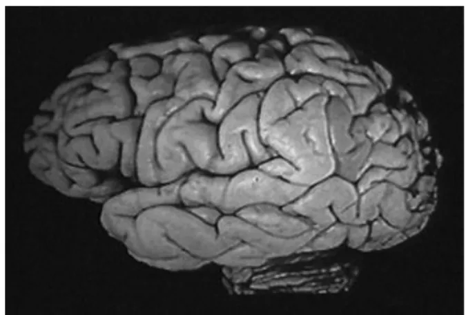Fig. A10 La alexia con agrafia se ha relacionada con una lesión que afecte  la circunvolución angular izquierda