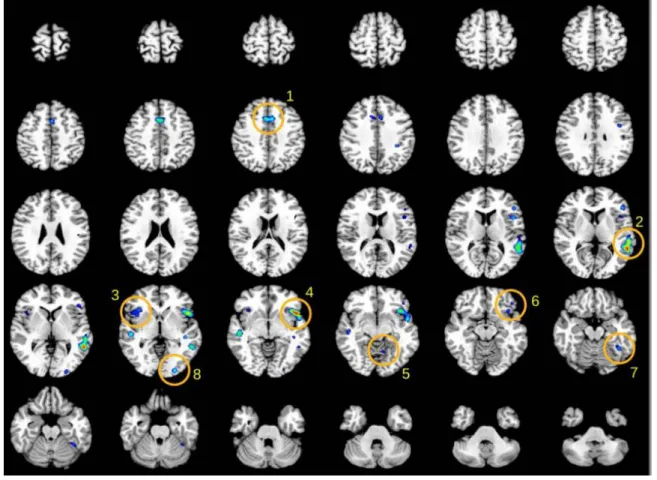Figure  1.  Functional  connectivity  map  of  BA22  by  Meta-analytic  Connectivity  Modeling