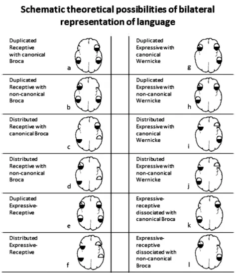 Fig. 1. Possible bilateral language representation based on two by two factors: receptive vs