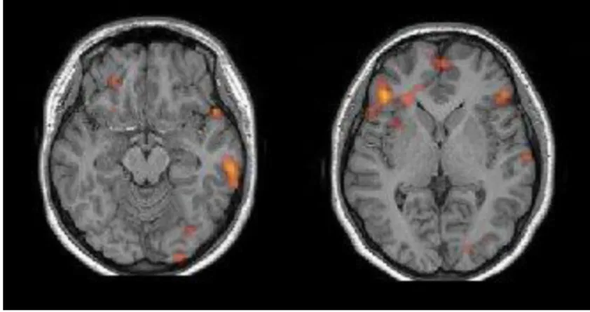 Fig. 3. Bilateral Broca’s and left Wernicke’s area Orientation and background image as in Fig