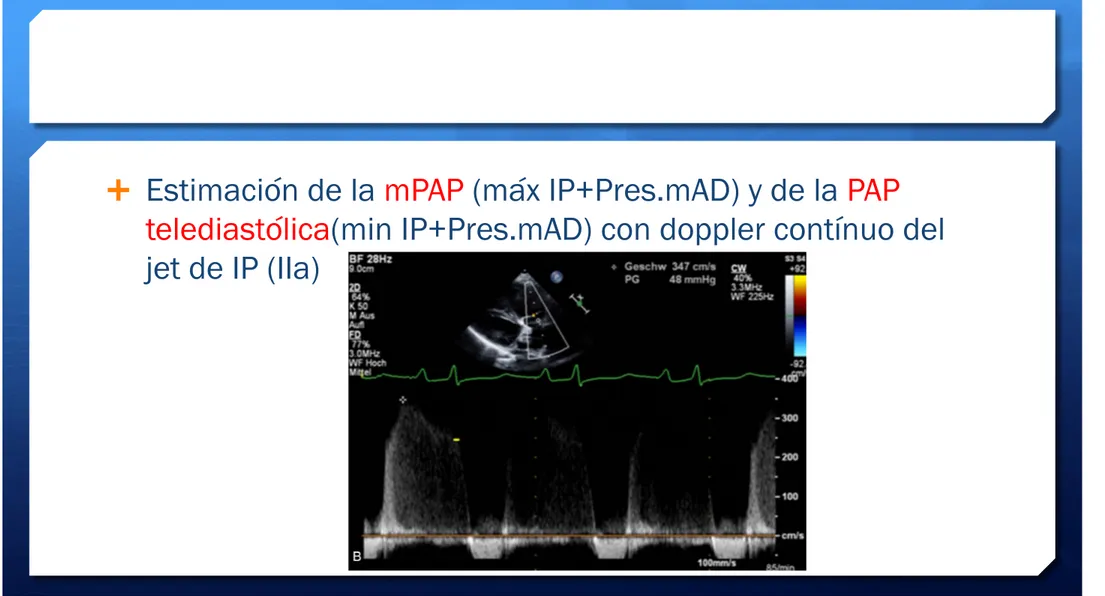 Figure 1 Estimation of RV and PA pressure using continuous wave (CW)-Doppler echocardiography